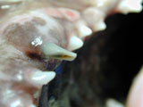 Zahnfraktur der Milcheckzähne mit Abzess und Fistel