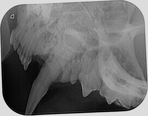 massive parodontitis mit vertikalem abbau des alveolarknochens und forl am wurzelzement mit verlust des parodontalspaltes