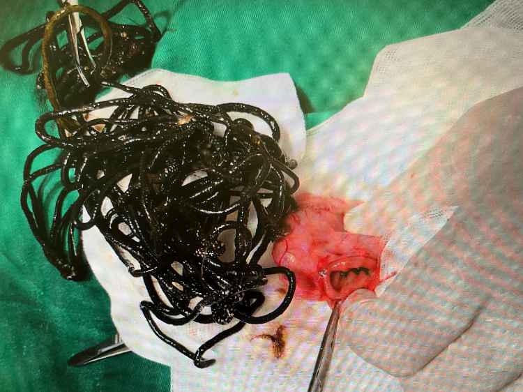 Gummis operativ aus dem Magen entfernt